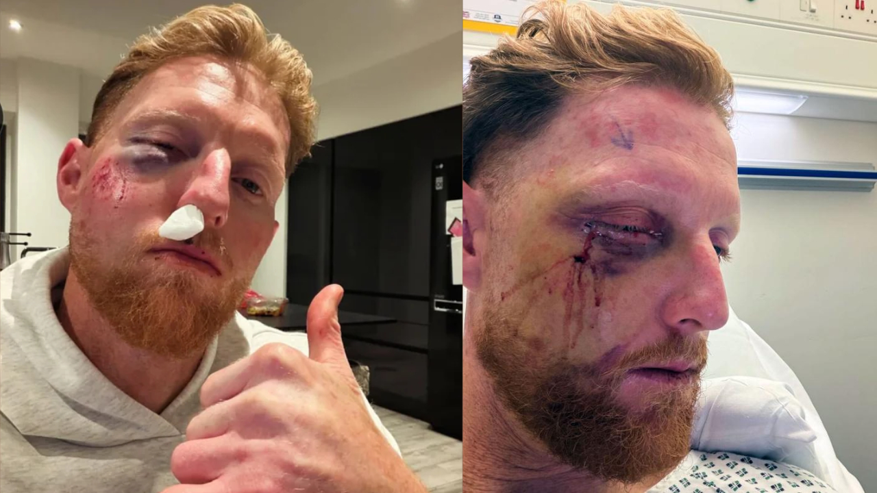 Ben Stokes Injury