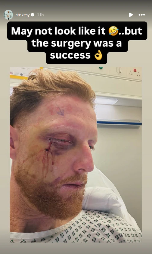Stokes Eye Injury